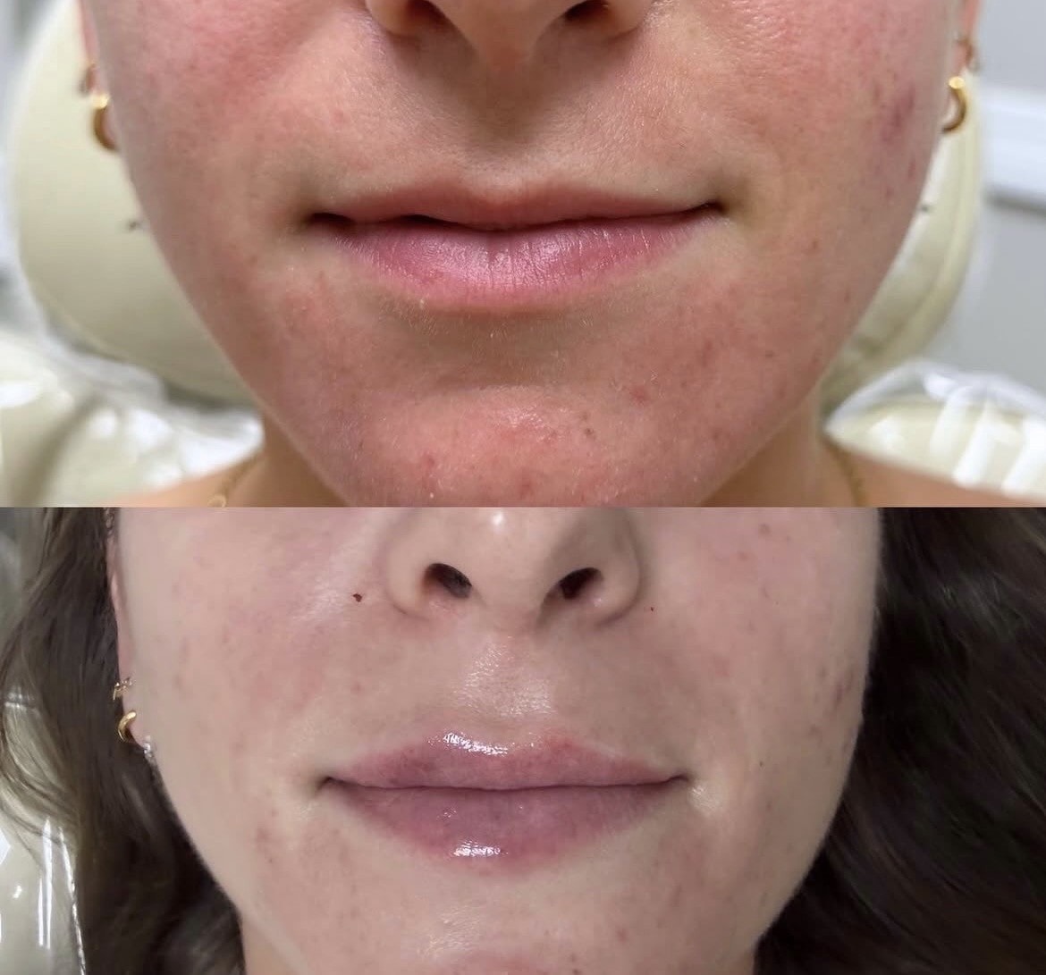 Dermal filler result 1 — Englewood Spine & Aesthetics Institute