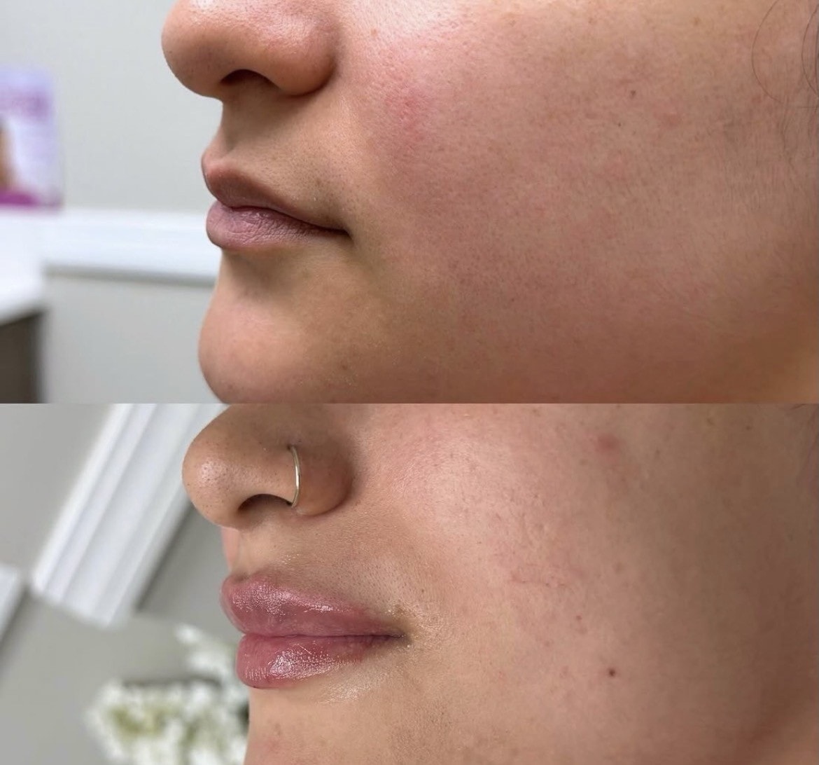 Dermal filler result 2 — Englewood Spine & Aesthetics Institute