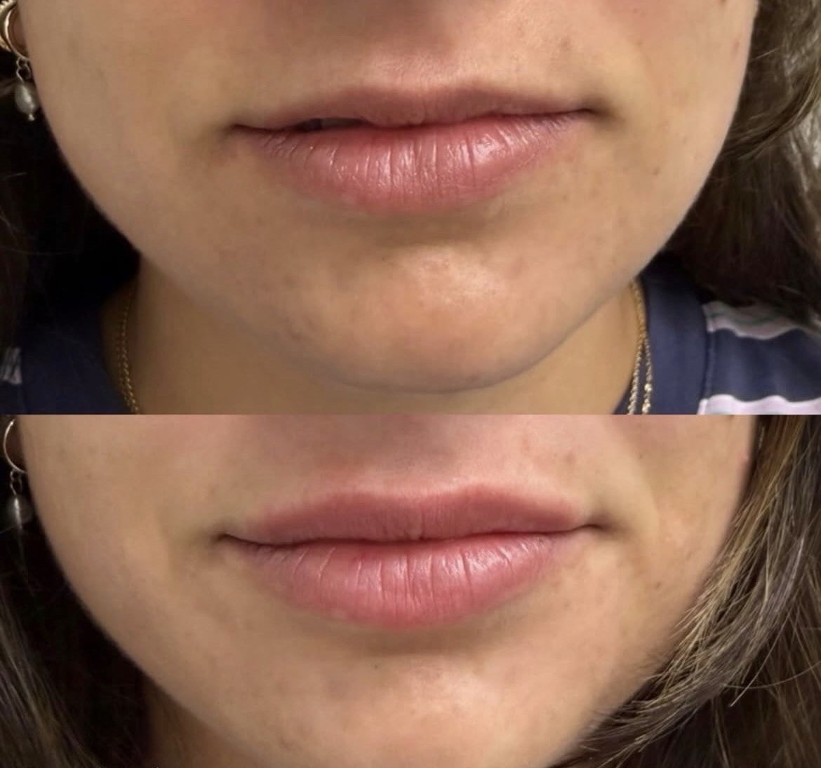 Dermal filler result 3 — Englewood Spine & Aesthetics Institute